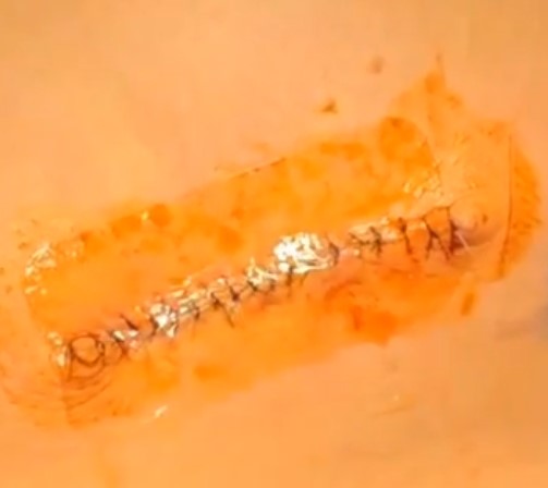 하큐어패치(HA CURE Patch)